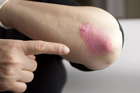 august is national psoriasis awareness month