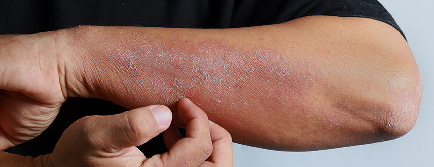 The dry winter months can be especially difficult for those suffering from psoriasis.